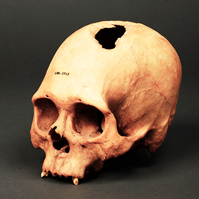 頭の頂部に穴のあいた頭蓋骨の写真